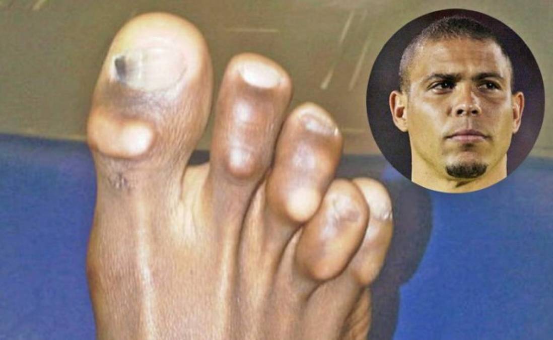 Los pies más horribles de los deportistas famosos