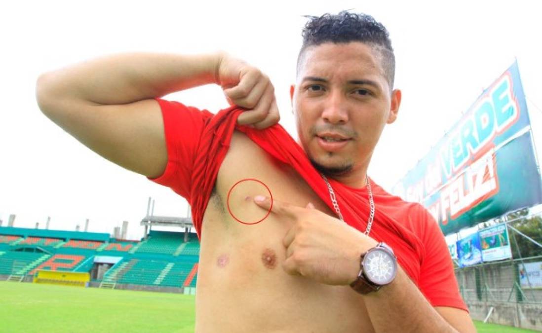 Futbolista Bryan Castro jugará con una bala en su cuerpo
