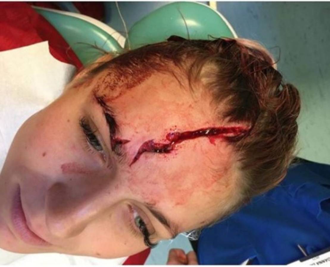 La bella portera del Liverpool sufre un escalofriante corte en la cabeza y muestra su cicatriz