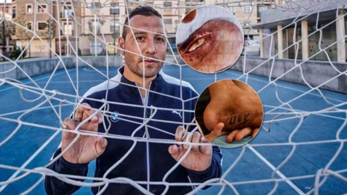 Impactante: La lesión que tiene retirado del fútbol a bicampeón de Euro con España