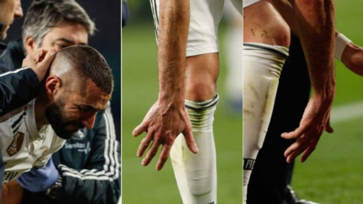 Benzema y la misteriosa lesión en su mano: Así tiene el dedo y aclara por qué no se opera