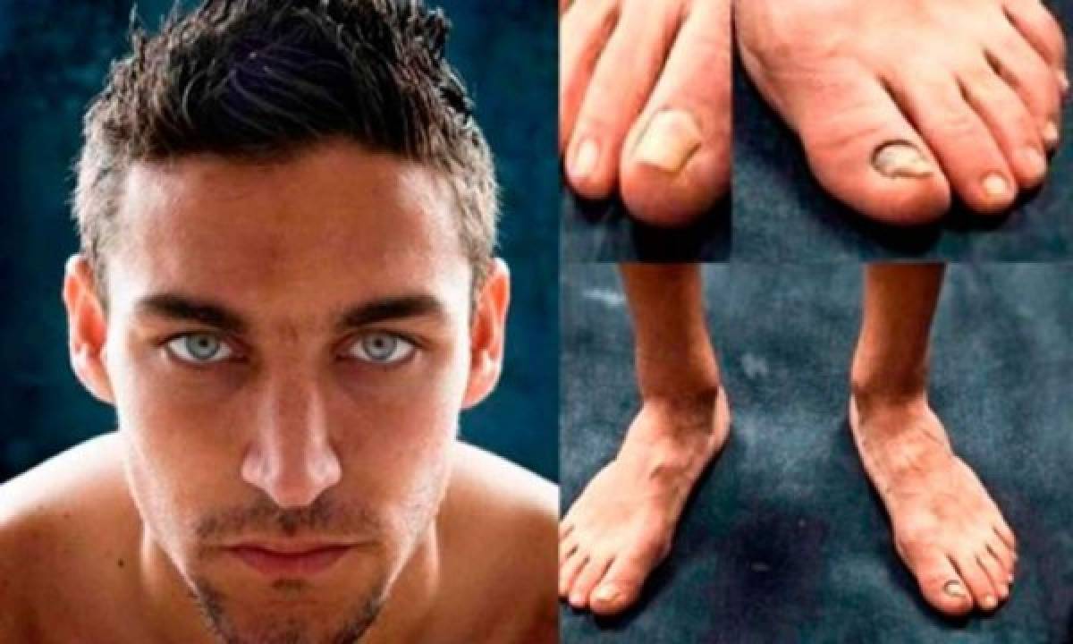 FOTOS: Así son los pies más feos de algunos deportistas reconocidos