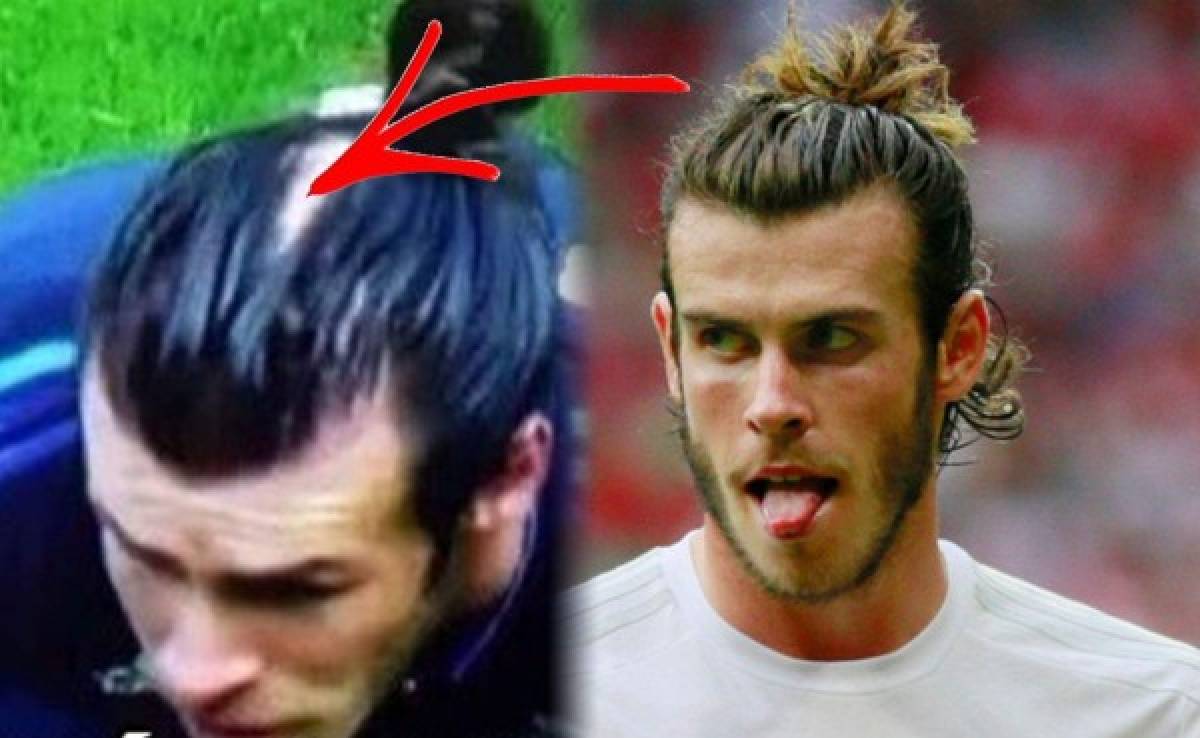 Impensado: Gareth Bale se está quedando...¡Calvo!