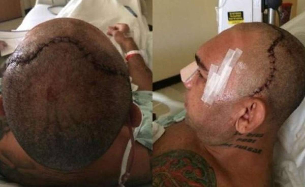Luchador Evangelista Santos﻿ muestra el cráneo reconstruido tras brutal rodillazo