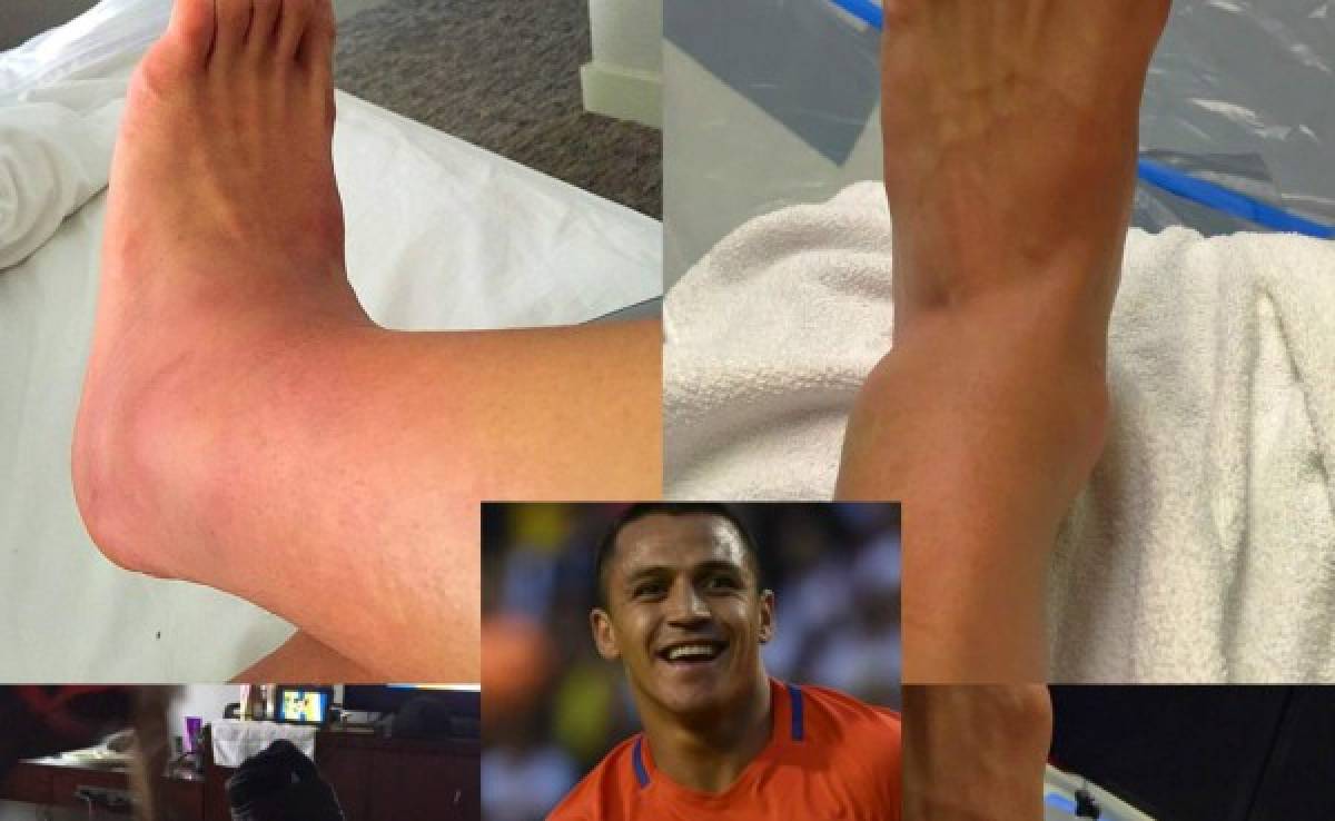 ¡Horroroso! Así termino el tobillo de Alexis Sánchez tras ganar la Copa América