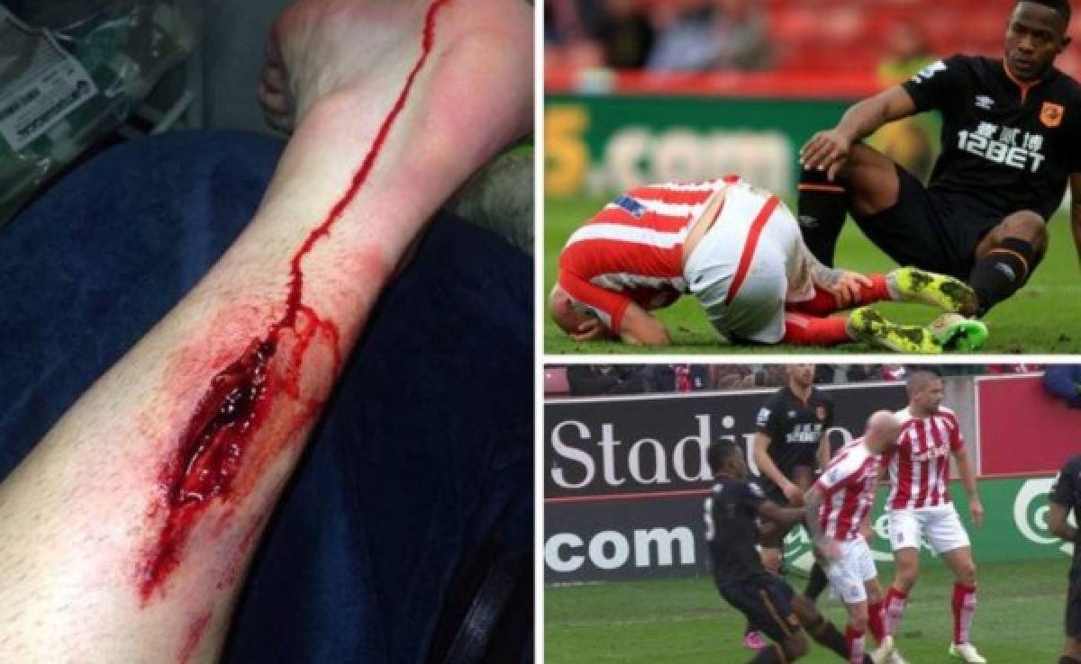 Figueroa le provoca espeluznante herida a jugador del Stoke City