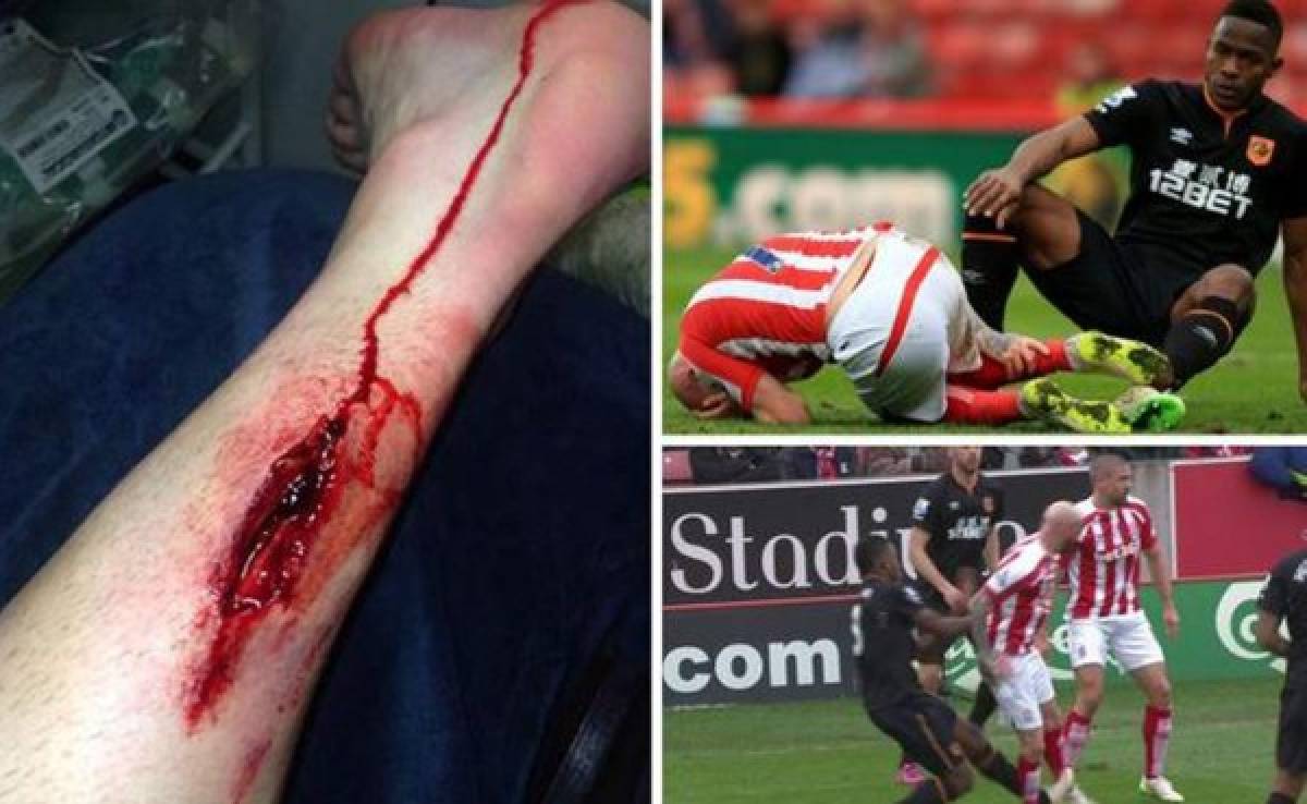 Figueroa sobre lesión a jugador del Stoke: 'Es un deporte de contacto'