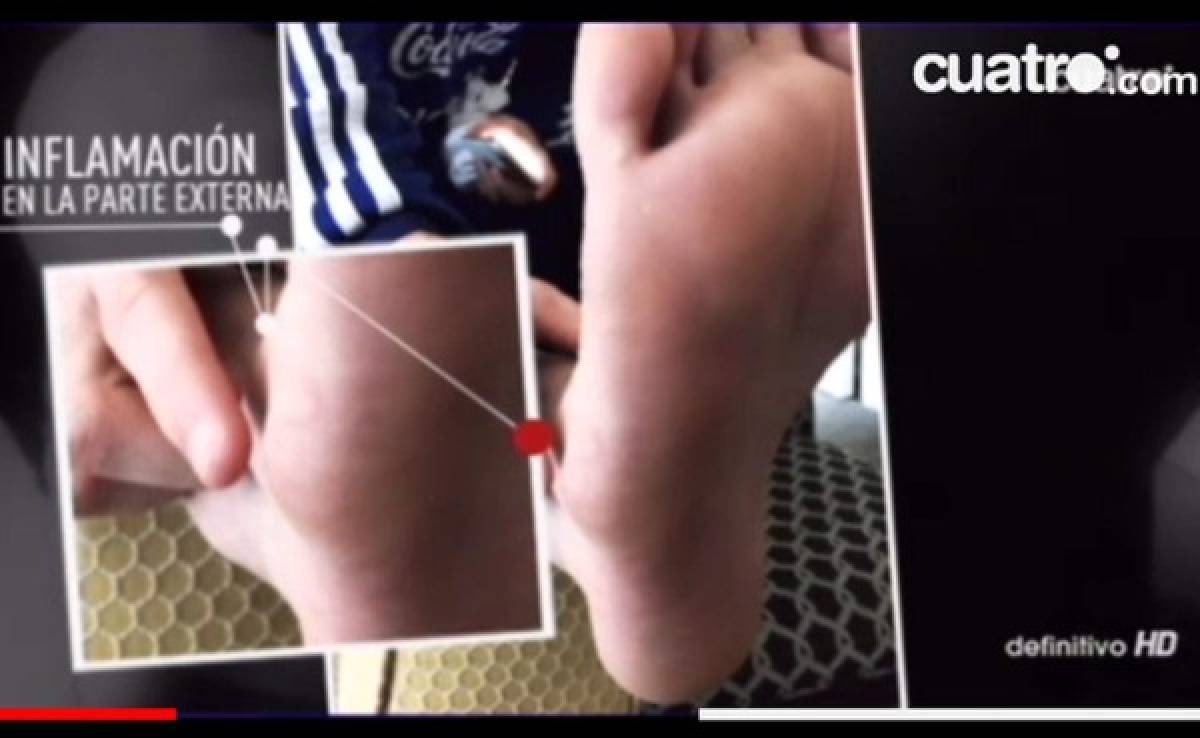 VIDEO: Así se ve el pie inflamado de Lionel Messi