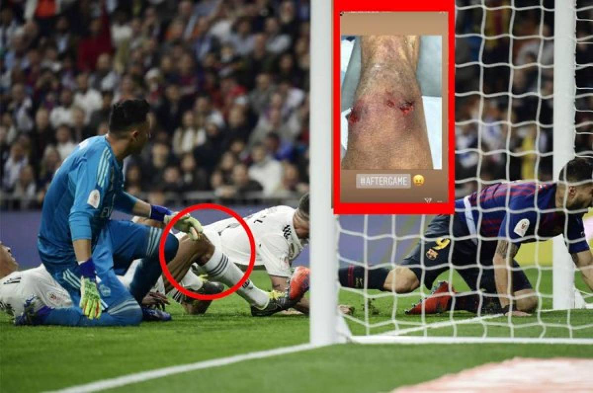 La escalofriante lesión de Varane en el clásico Real Madrid-Barcelona