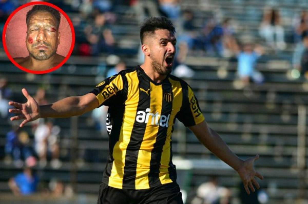 Lucas Viatri, futbolista argentino sufre graves quemaduras con pirotecnia