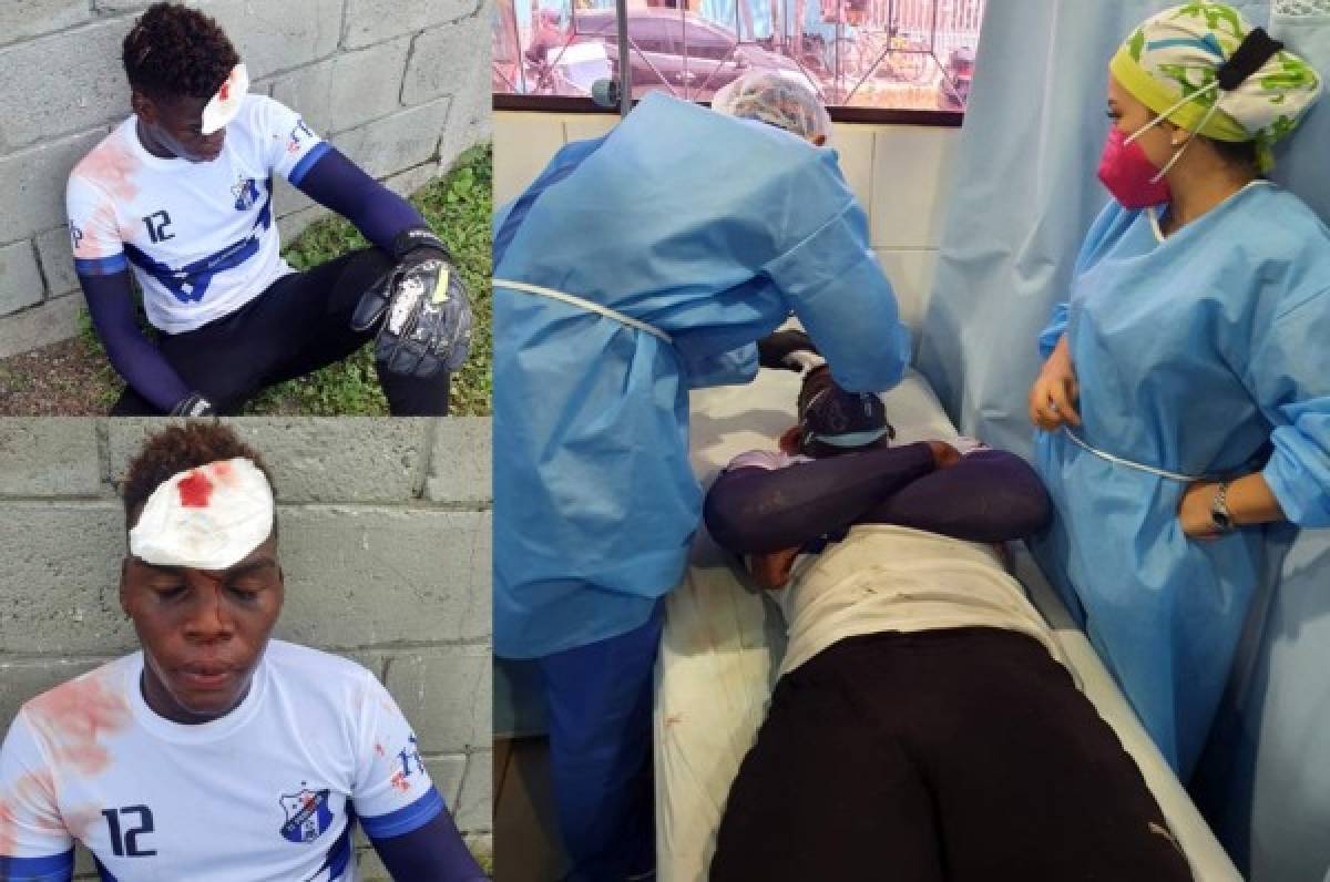 Jugador del Honduras Progreso termina con seis puntos de sutura tras durísimo choque