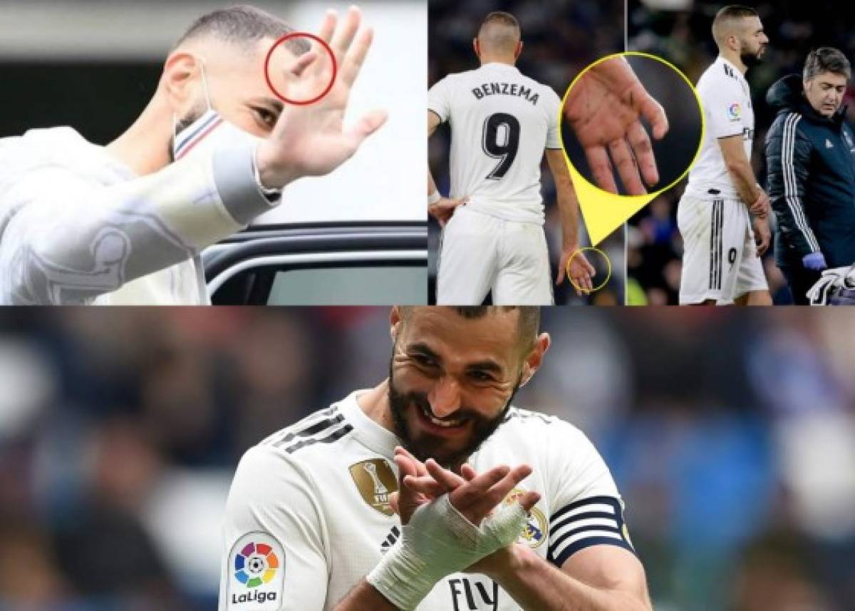 Benzema y la misteriosa lesión en su mano: Así tiene el dedo y aclara por qué no se opera