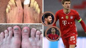 Thomas Müller, estrella del Bayern Munich, sorprendió a todos al mostrar sus pies y entra en el top de los más feos.