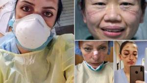 Doctores y paramédicos de todo el mundo muestran las secuelas en sus rostros en esta lucha contra el coronavirus en los hospitales de diversas ciudades del mundo.