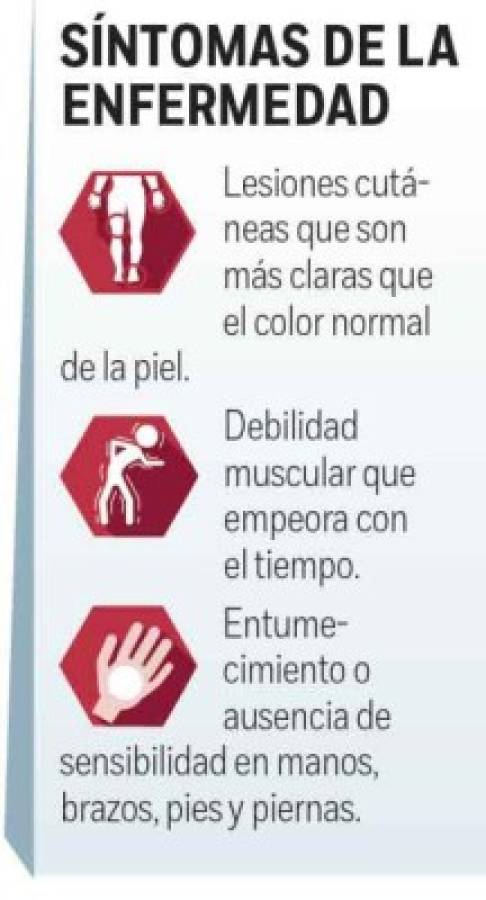 Alerta en México tras reportarse 89 casos de lepra, algo que pone en vigilancia al sector salud