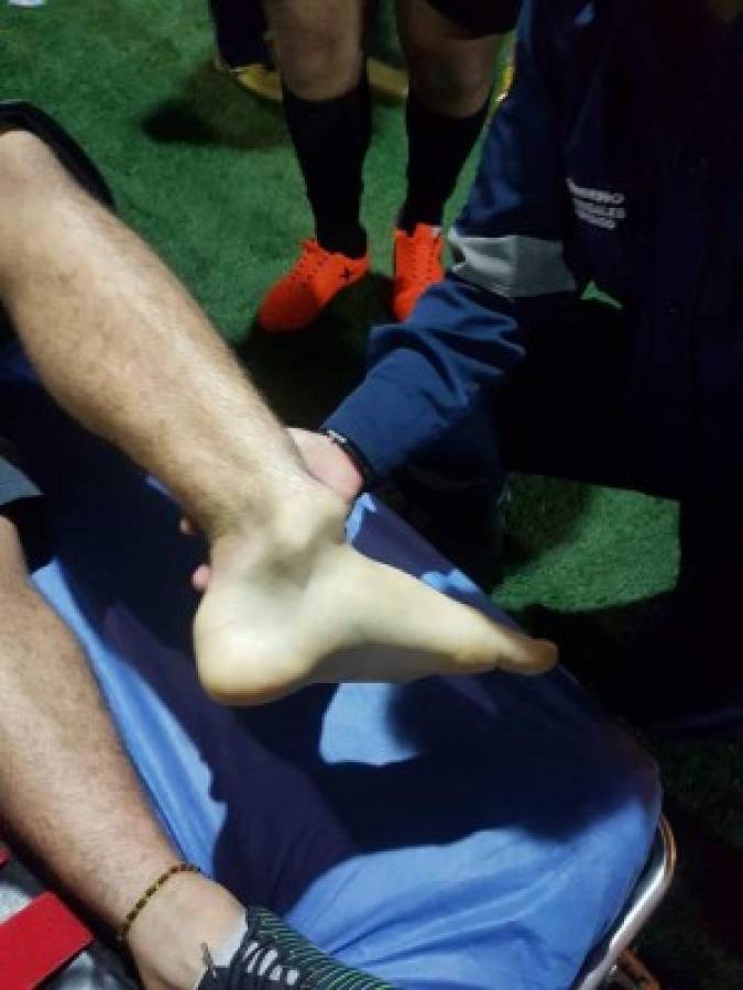Dolorosas imágenes: así quedó el tobillo de Santiago Arias tras sufrir terrible lesión en el Colombia-Venezuela