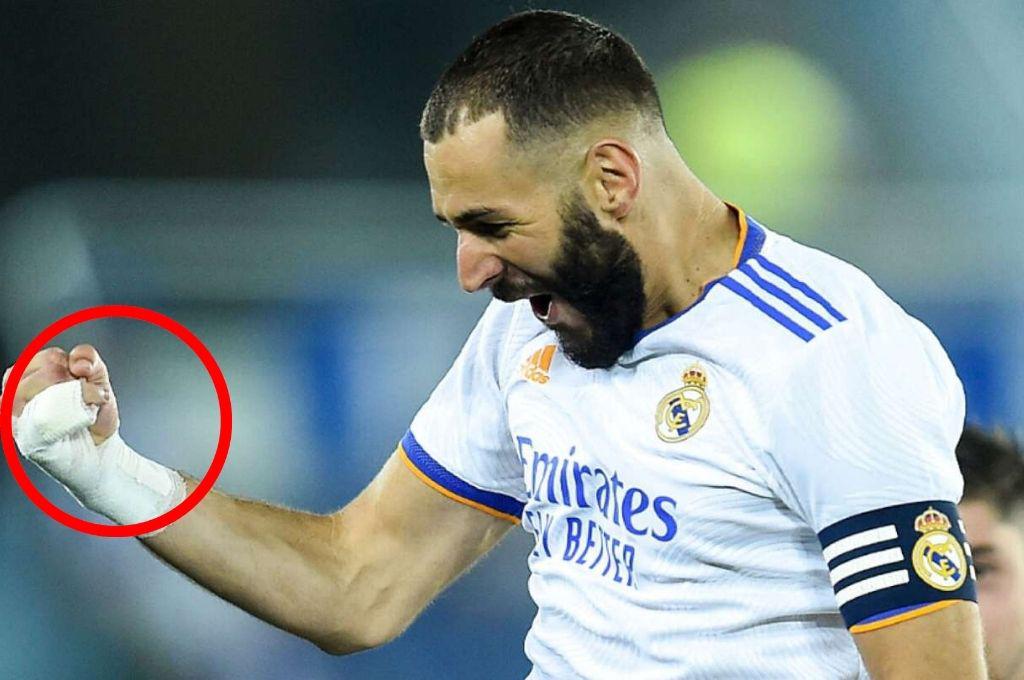 Impactante el estado de su meñique: Benzema muestra su dedo sin vendaje; lleva tres años así