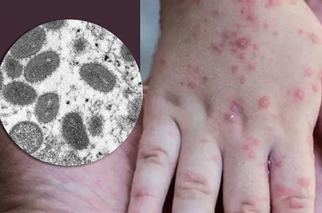 Emergencia internacional: La OMS activa su máximo nivel de alerta por la viruela del mono