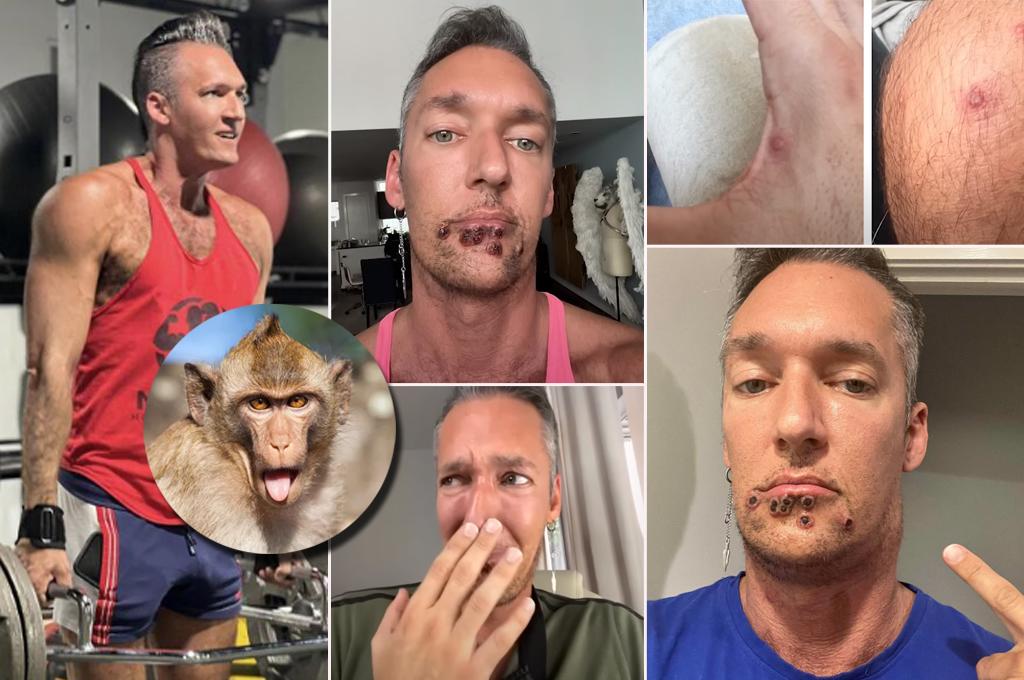 La pesadilla que vive un paciente con viruela del mono y muestra cómo tiene su cara: ‘‘Duele existir; este no soy yo’’