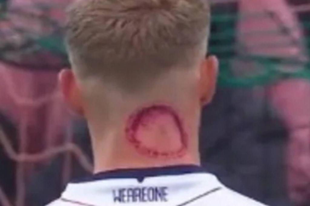 ¿Qué es lo que tiene? la llamativa marca que mostró un futbolista en su cuello y explica todo: Es una mordida zombie”