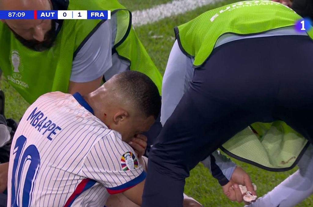 Fotos: Así le quedó la nariz a Mbappé tras rompérsela y lo que informan desde Francia sobre su lesión: “Es lo malo de esta noche”