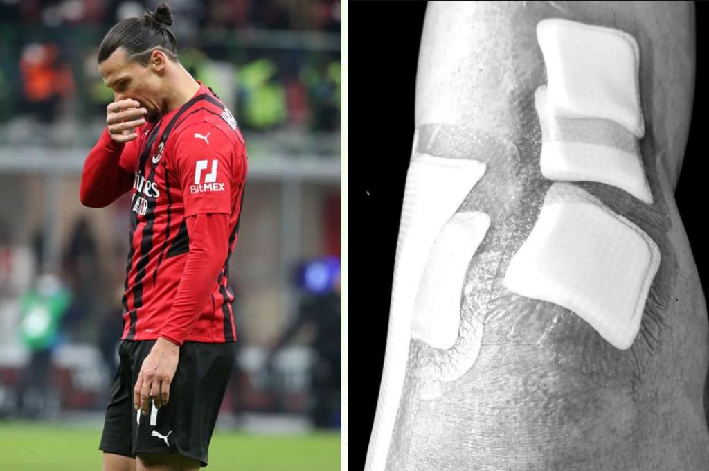 ¡Desgarrador relato! Zlatan Ibrahimovic destapa su calvario en Milán: “Casi no dormí durante seis meses por el dolor”
