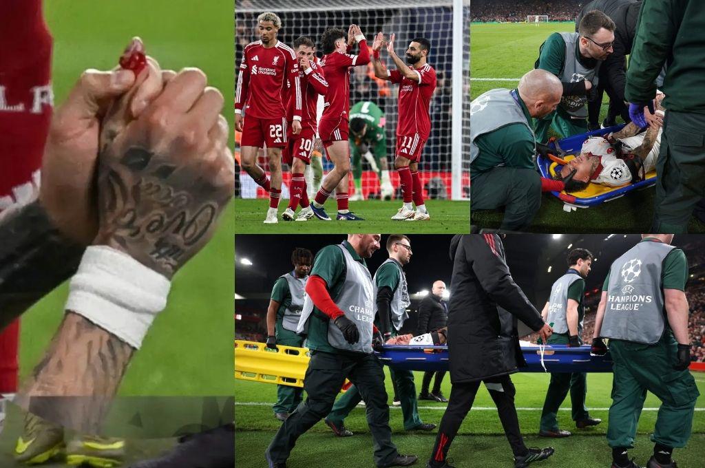 Amputaron su dedo tras ser eliminado de la Champions: la escalofríante imagen que se vivió en Anfield