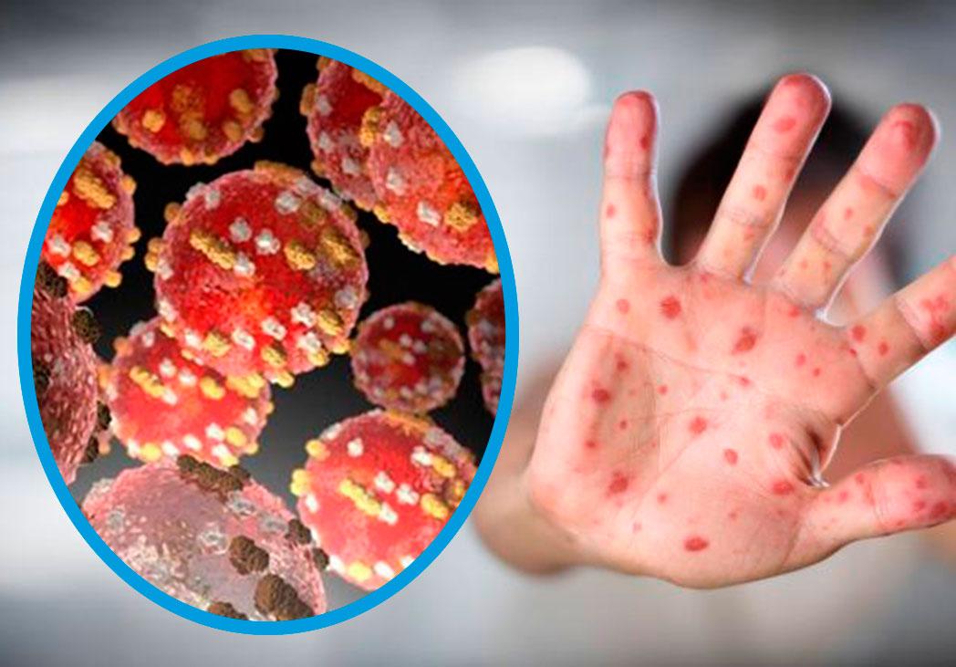 El mundo en alerta ante raros brotes de viruela del mono detectados en Norteamérica y Europa