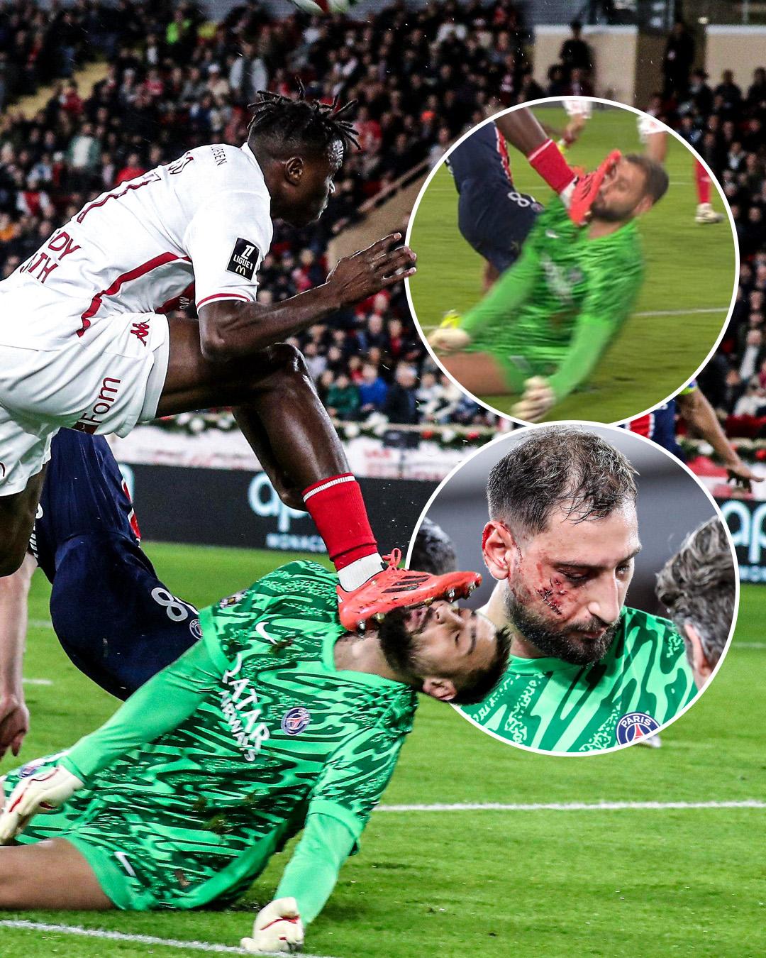 La impactante lesión de Donnaruma que recibió una patada en el rostro y tuvo que ser reemplazado ante Mónaco