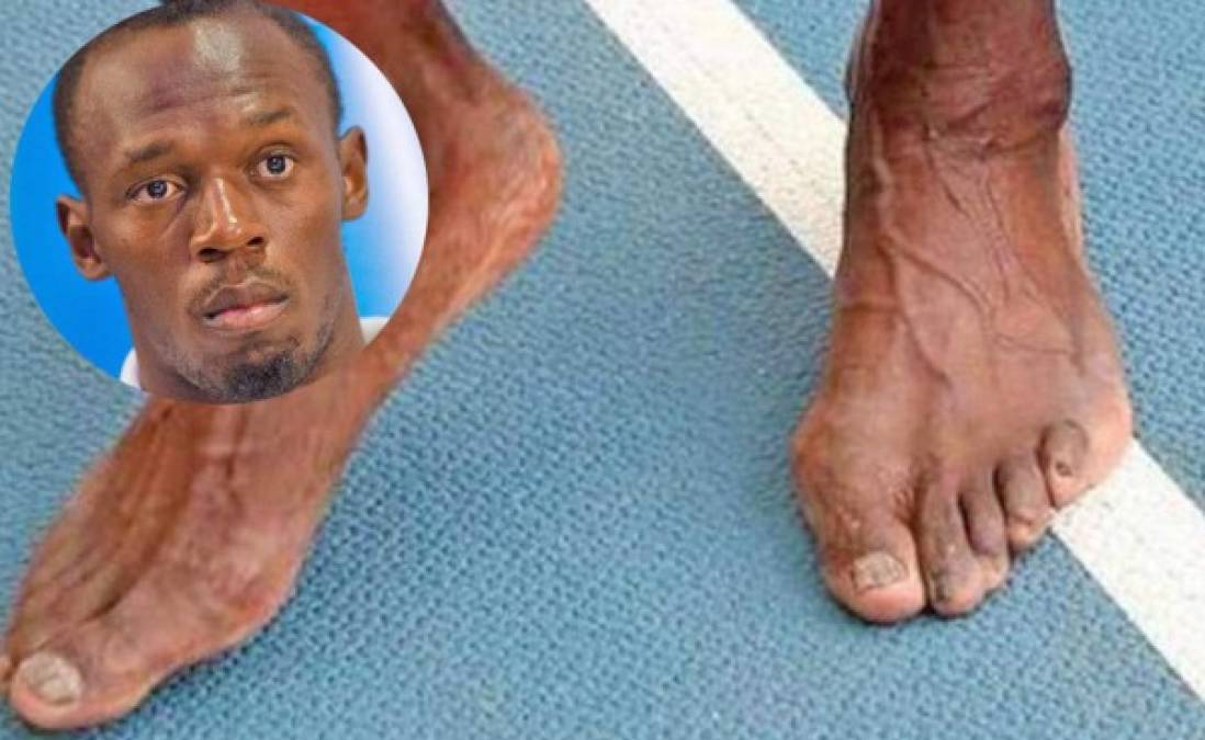 Los pies más horribles de los deportistas famosos
