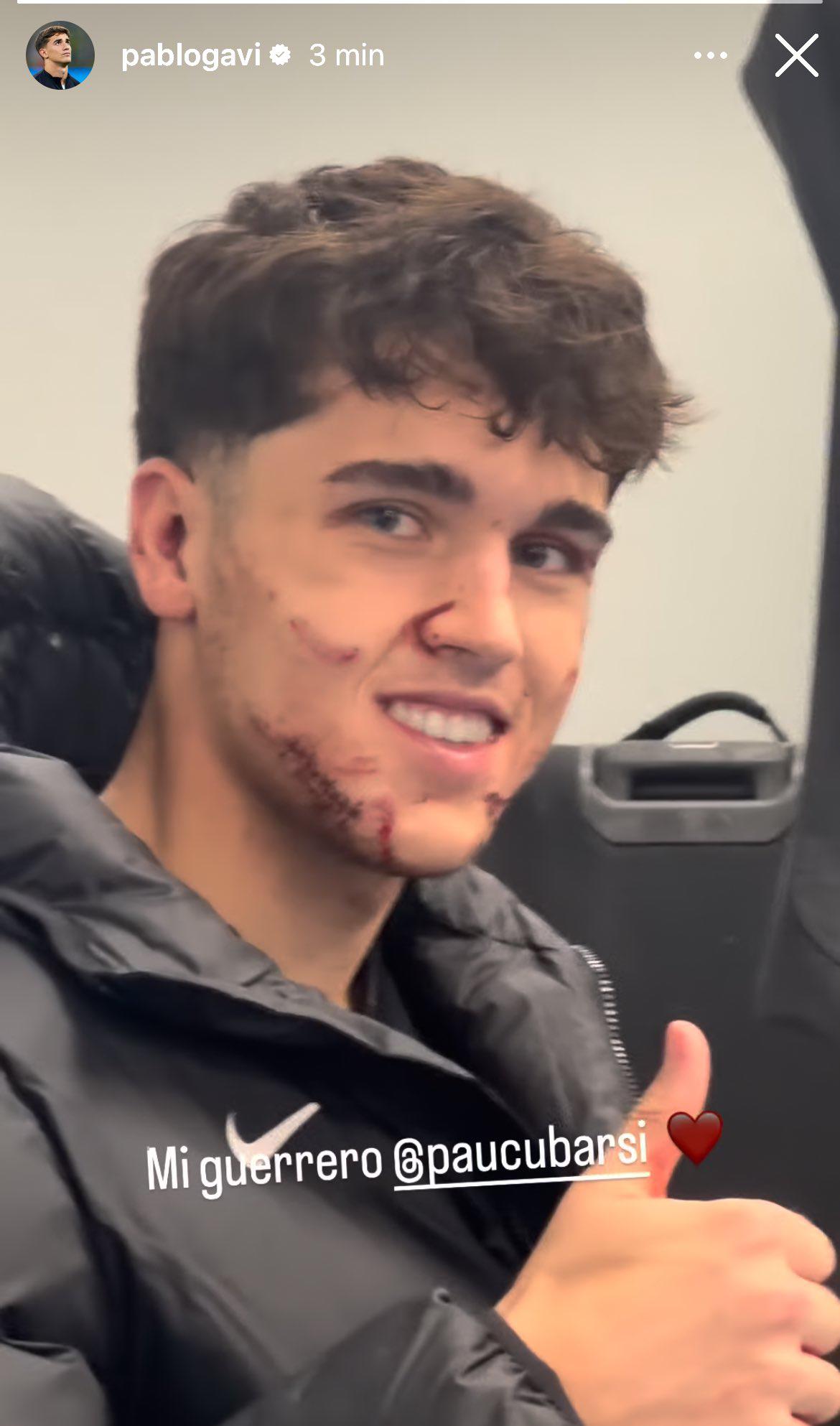 “Me salpicó su sangre, el corte es impactante”: así quedó la cara de Cubarsí tras sufrir una patada en la Champions