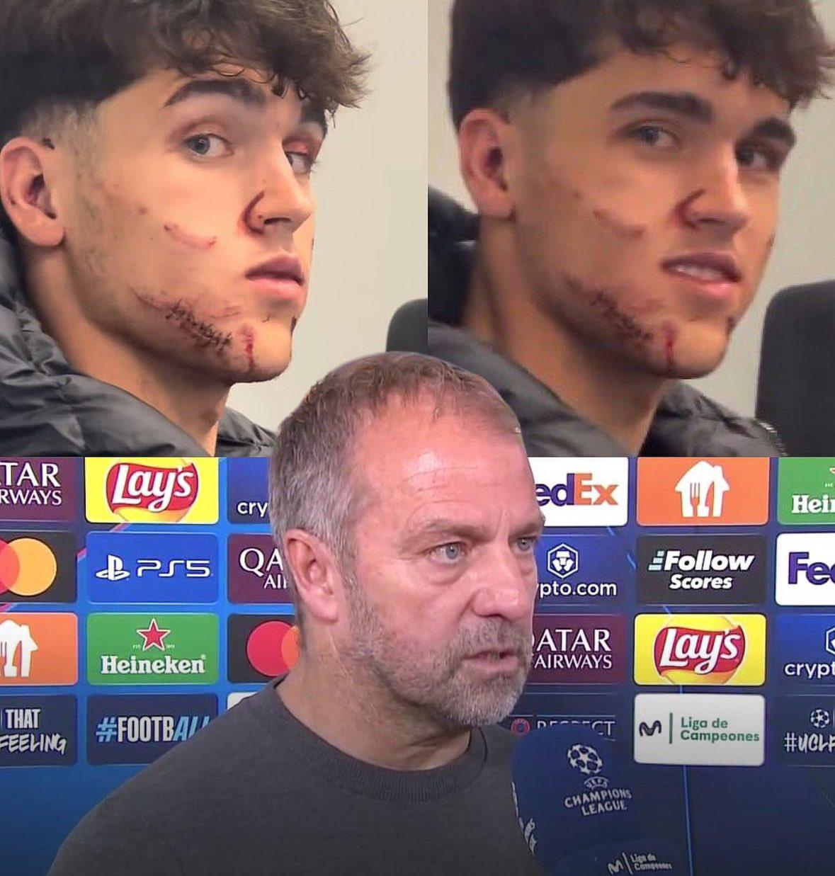 “Me salpicó su sangre, el corte es impactante”: así quedó la cara de Cubarsí tras sufrir una patada en la Champions