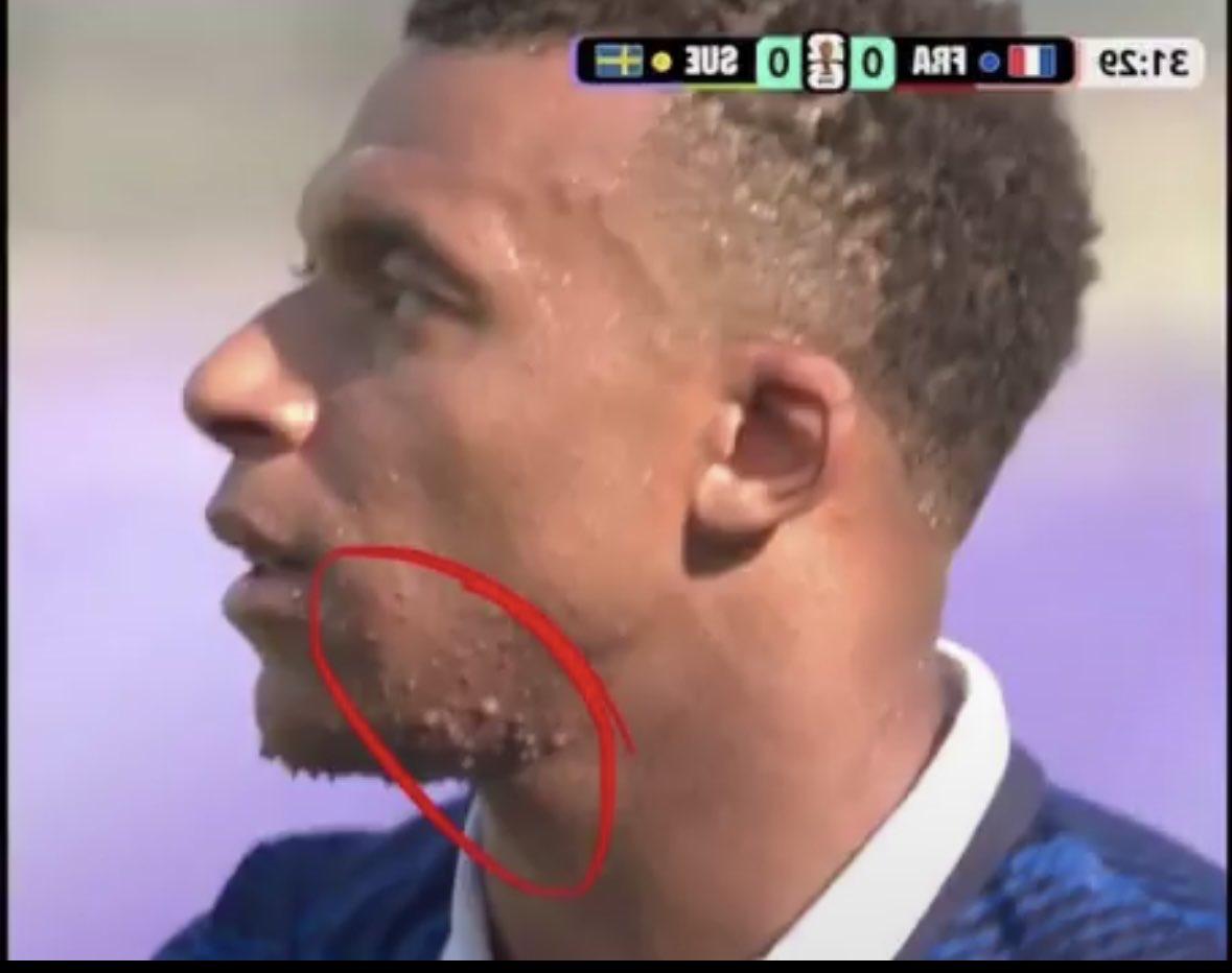 Mbappé y las marcas en su cara: ¿Qué está pasando con el crack de Francia y Real Madrid?