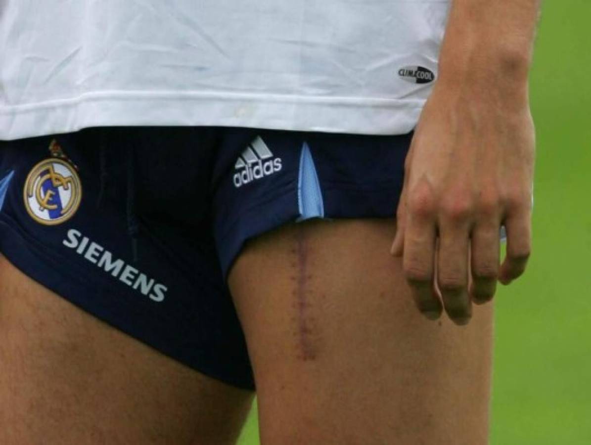 Escalofriantes: Las cicatrices más impactantes que han sufrido futbolistas y otros deportistas