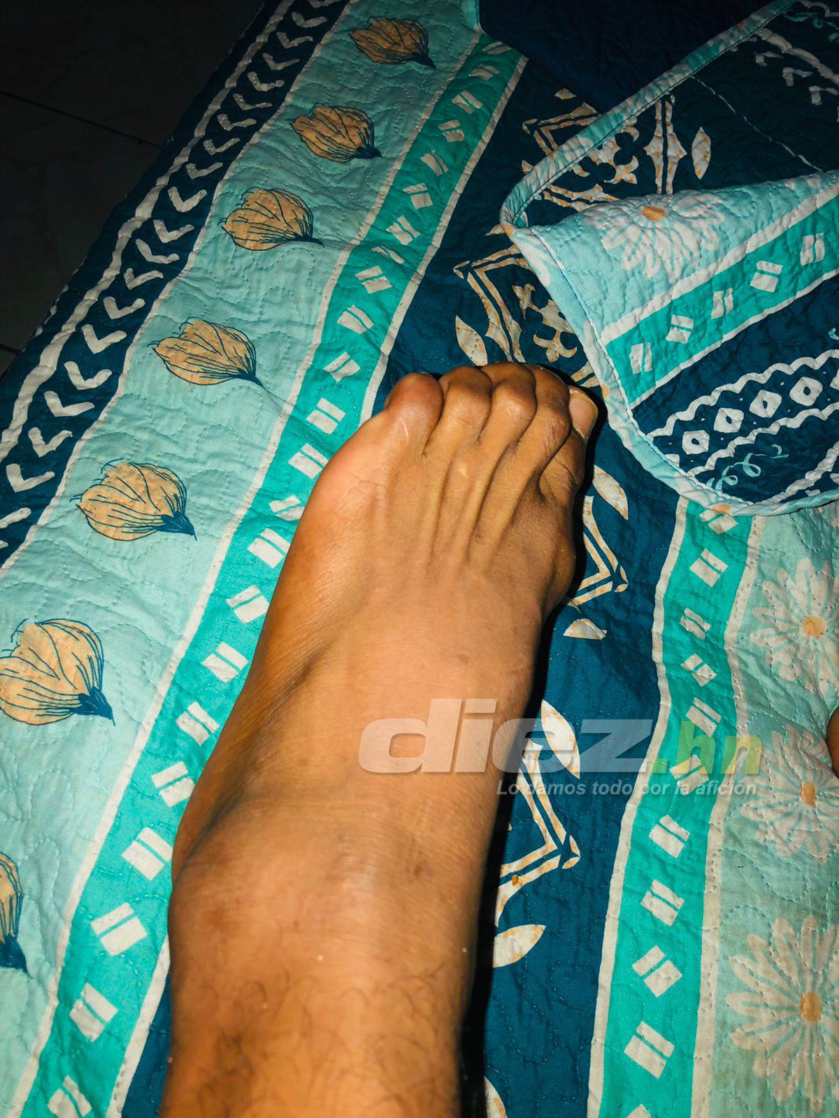 Alexy Vega tardará al menos dos meses para recuperarse de su lesión en el tobillo.