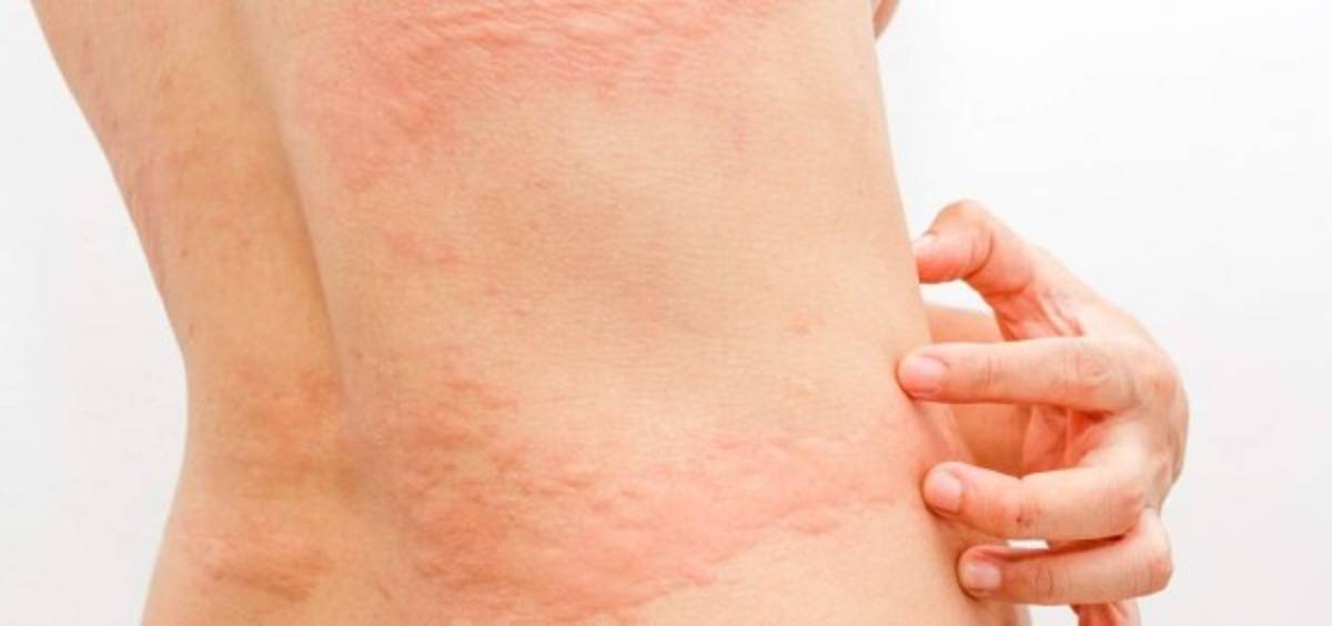 Nuevos síntomas del coronavirus: Las cinco manifestaciones que se producen en la piel  