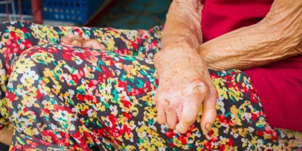 Alerta en México tras reportarse 89 casos de lepra, algo que pone en vigilancia al sector salud