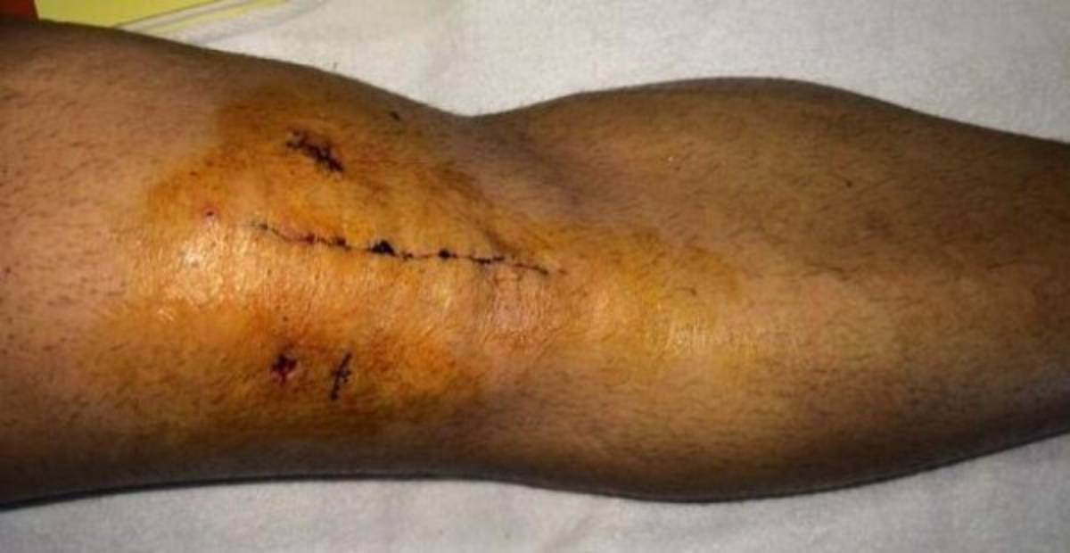 Escalofriantes: Las cicatrices más impactantes que han sufrido futbolistas y otros deportistas