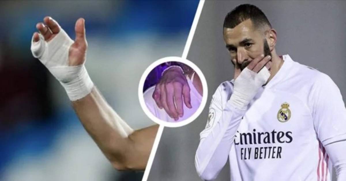 Benzema y la misteriosa lesión en su mano: Así tiene el dedo y aclara por qué no se opera