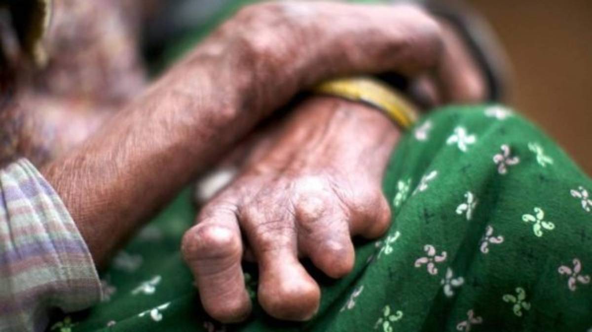 Alerta en México tras reportarse 89 casos de lepra, algo que pone en vigilancia al sector salud