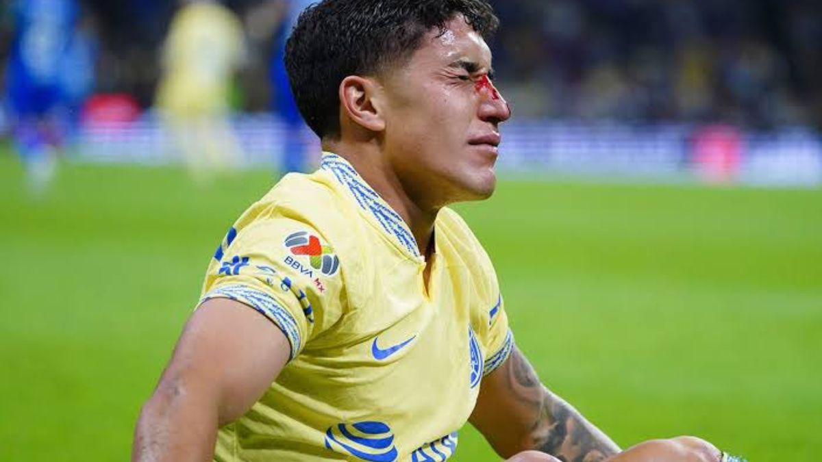 ¡Imágenes sensibles! La dolorosa fractura de nariz de Alex Zendejas en el América- Monterrey ¿Cómo le quedó el golpe?