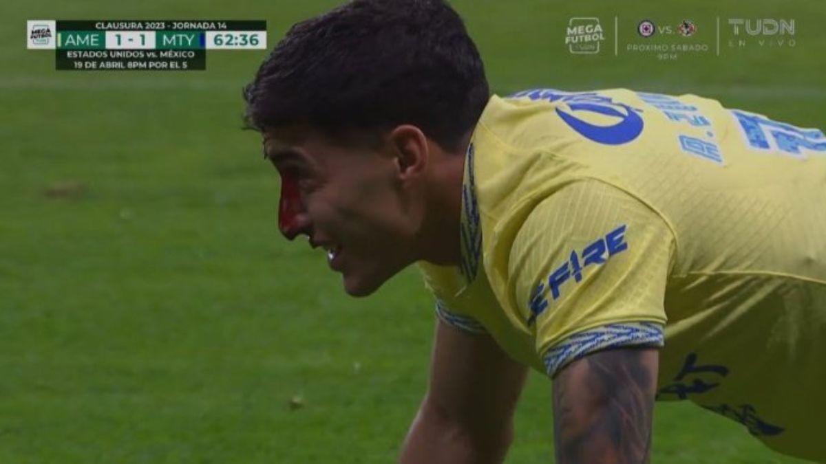 ¡Imágenes sensibles! La dolorosa fractura de nariz de Alex Zendejas en el América- Monterrey ¿Cómo le quedó el golpe?