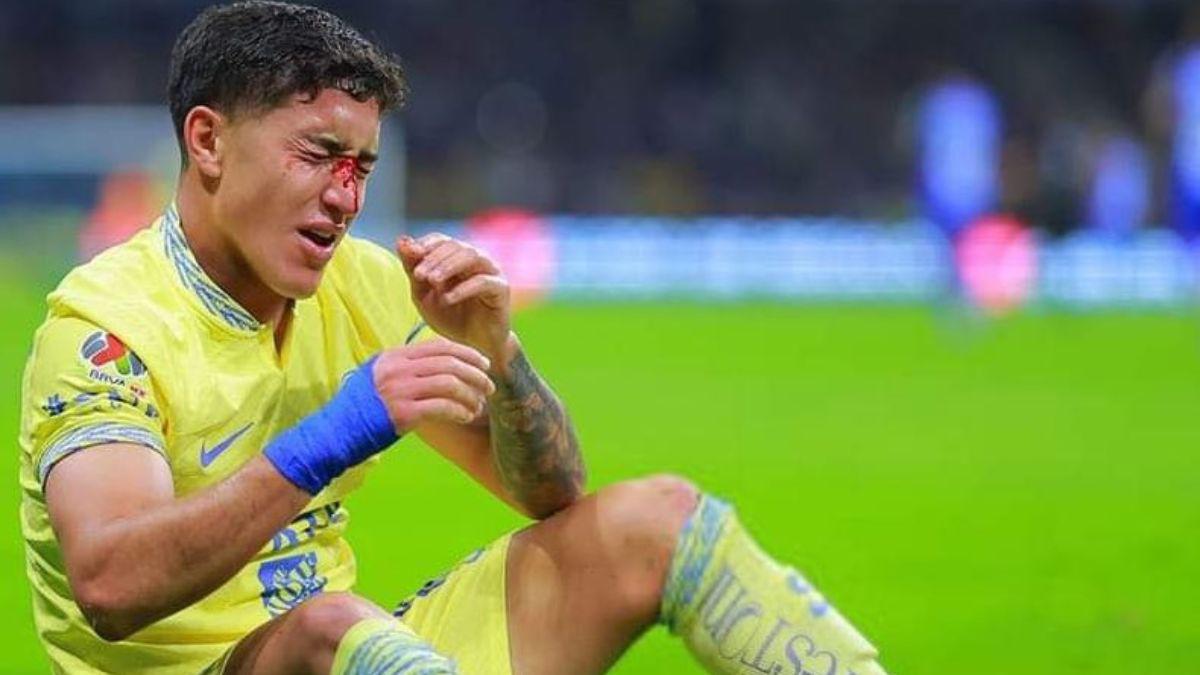 ¡Imágenes sensibles! La dolorosa fractura de nariz de Alex Zendejas en el América- Monterrey ¿Cómo le quedó el golpe?