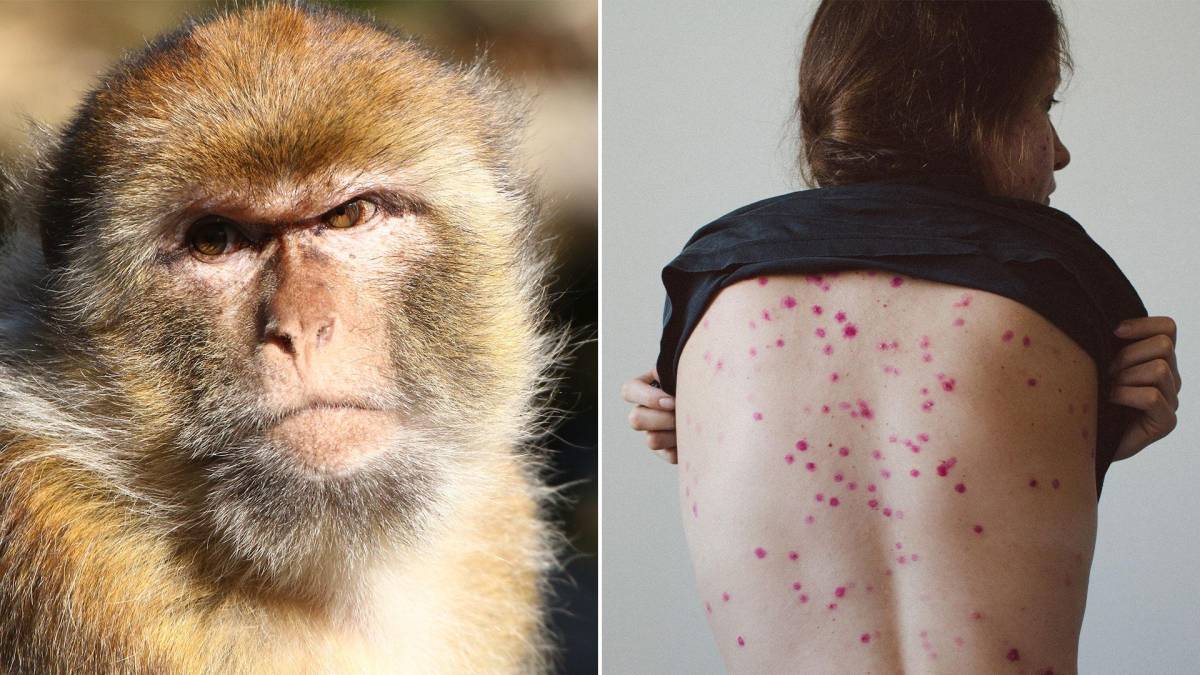 Confirmado: Honduras ya reporta el primer caso de viruela de mono; “Sus contactos están también aislados”