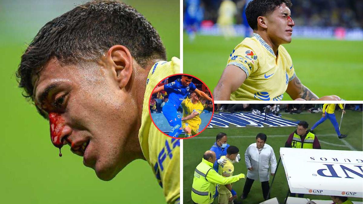 ¡Imágenes sensibles! La dolorosa fractura de nariz de Alex Zendejas en el América- Monterrey ¿Cómo le quedó el golpe?