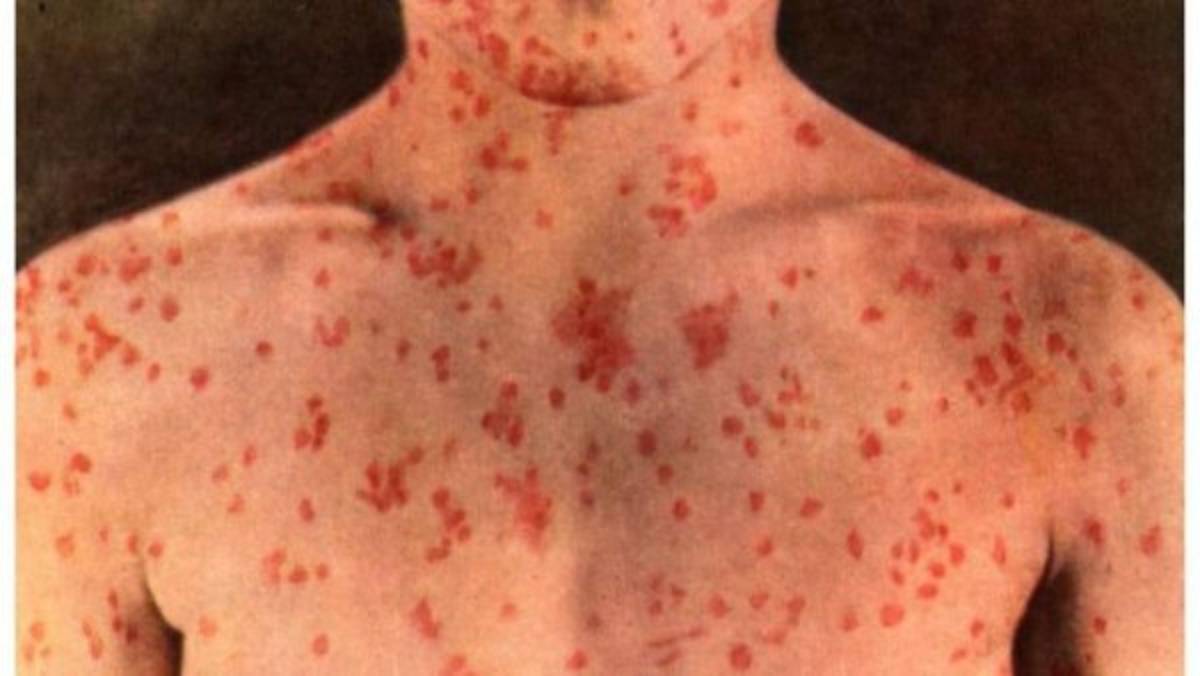 Las pandemias más mortíferas que han azotado a la humanidad a lo largo de la historia