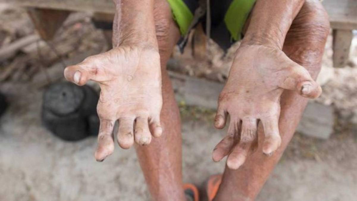 Alerta en México tras reportarse 89 casos de lepra, algo que pone en vigilancia al sector salud