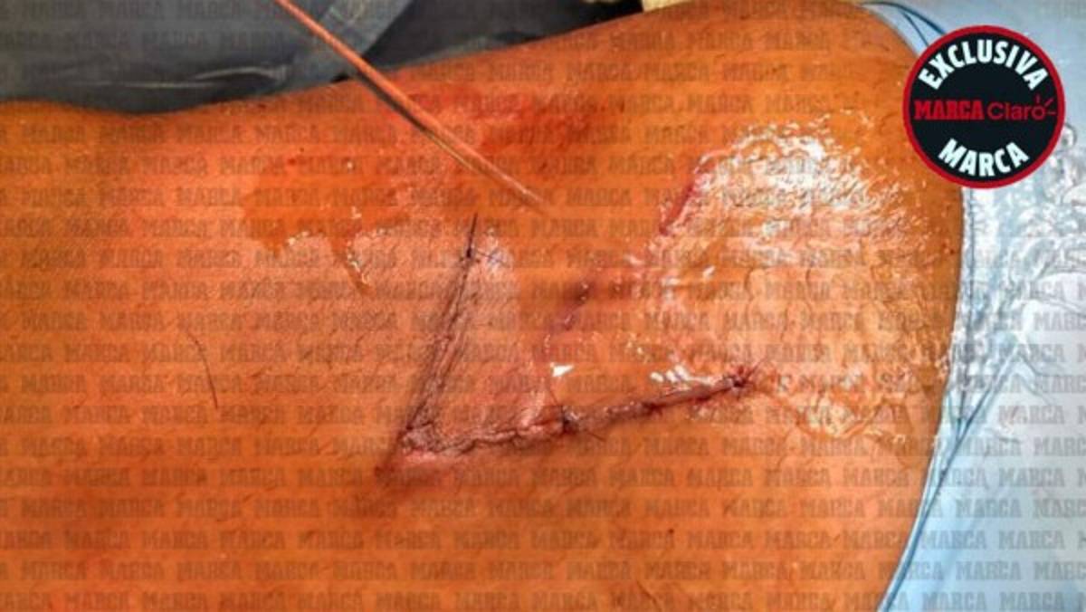 FOTOS: Reconstruyen el muslo de Gio Dos Santos tras lesión en el América-Chivas