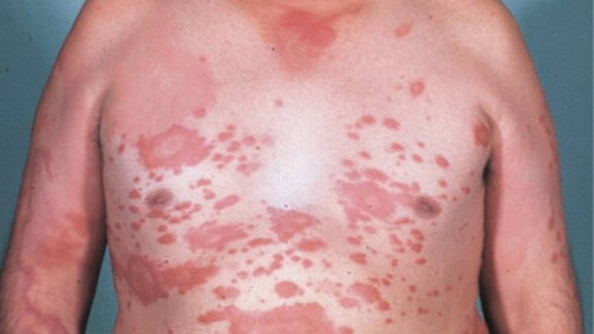 Alerta en México tras reportarse 89 casos de lepra, algo que pone en vigilancia al sector salud