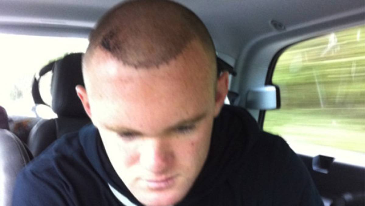 Rooney muestra su nuevo injerto de cabello
